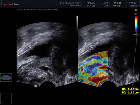 Bild Elastografie